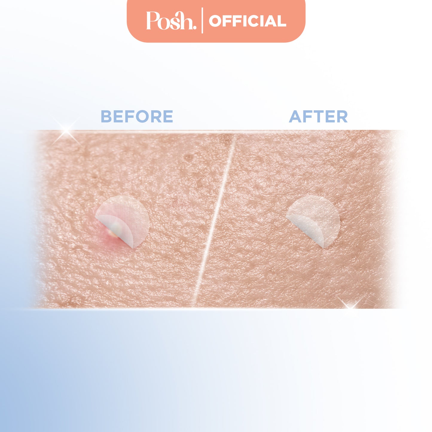 Microneedle - 9 Pack Pimple Patch